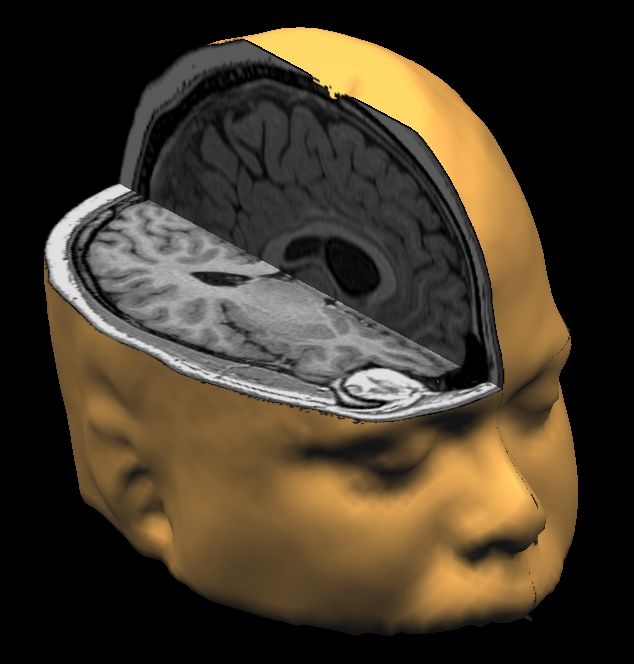 Brain implant helps stroke victim speak again