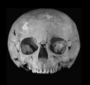 Oldest case of Down’s syndrome from medieval France